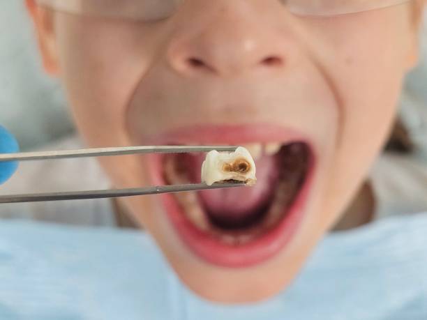 Best Emergency Dental Extractions in Hide A Way Lake, MS